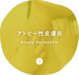 アトピー性皮膚炎 Atopic dermatitis