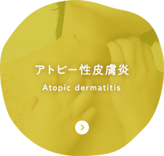 アトピー性皮膚炎 Atopic dermatitis